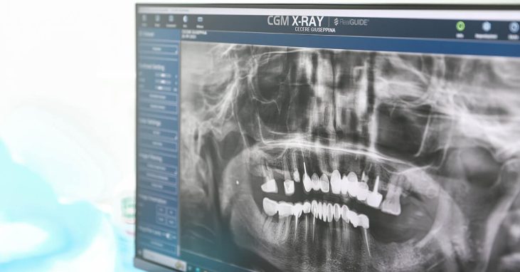 Impianti dentali a cosenza 4