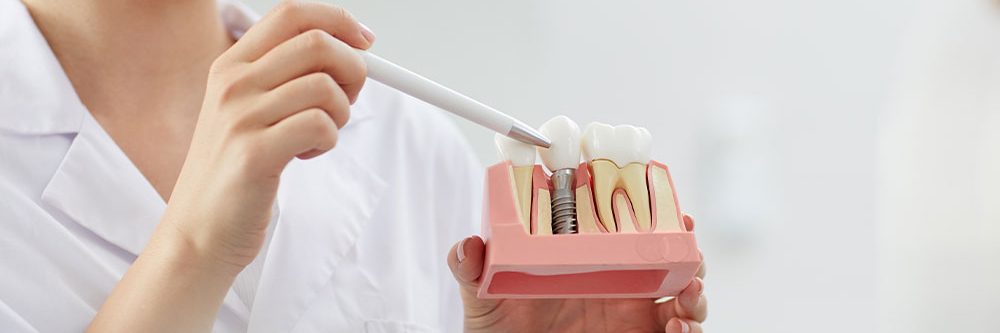 Impianti Dentali